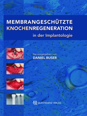 cover image of Membrangeschützte Knochenregeneration in der Implantologie